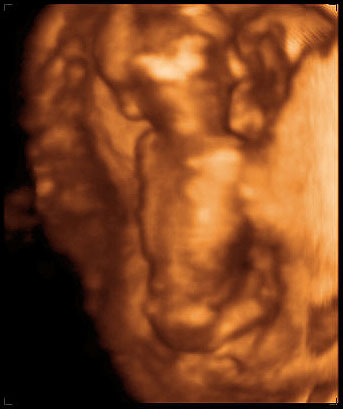 3d ultrasound image