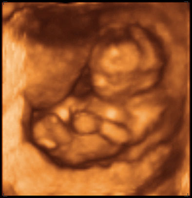 thumbnail of ultrasound at 14 weeks