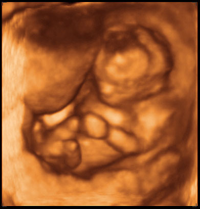 3d ultrasound image