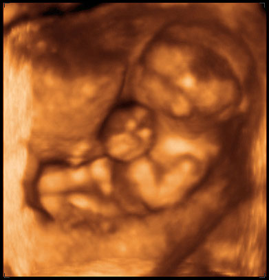 thumbnail of ultrasound at 14 weeks