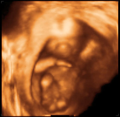 thumbnail of ultrasound at 15 weeks