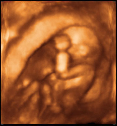 3d ultrasound image