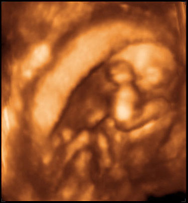 thumbnail of ultrasound at 15 weeks