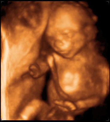 thumbnail of ultrasound at 18 weeks