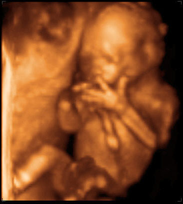 thumbnail of ultrasound at 18 weeks