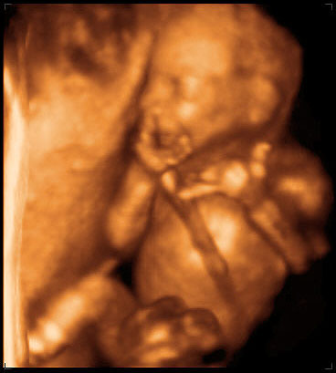 thumbnail of ultrasound at 18 weeks