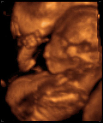 thumbnail of ultrasound at 18 weeks