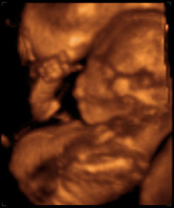 3d ultrasound image