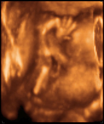 thumbnail of ultrasound at 18 weeks