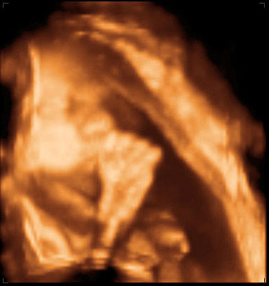 thumbnail of ultrasound at 29 weeks