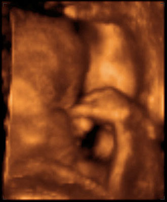 thumbnail of ultrasound at 29 weeks