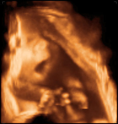 thumbnail of ultrasound at 29 weeks