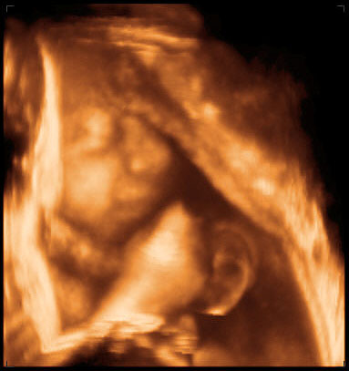 thumbnail of ultrasound at 29 weeks