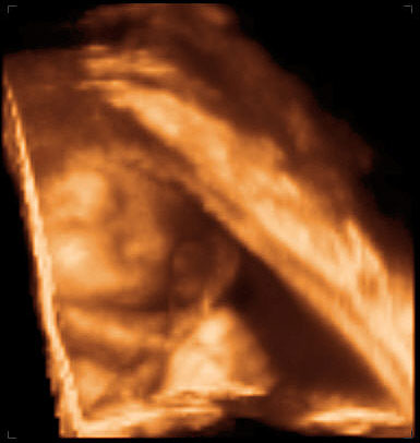 3d ultrasound image