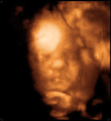 thumbnail of ultrasound at 29 weeks