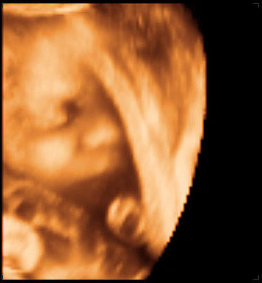 3d ultrasound image