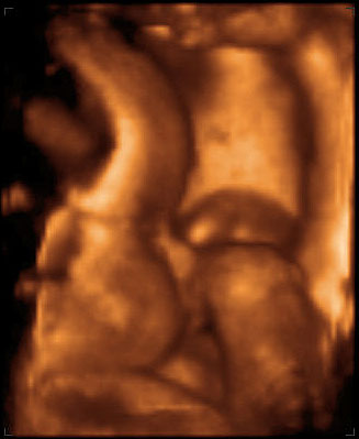 thumbnail of ultrasound at 29 weeks