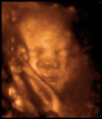 3d ultrasound image