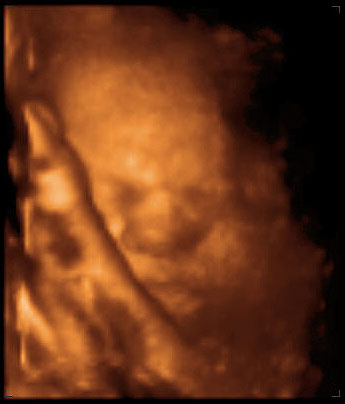 thumbnail of ultrasound at 31 weeks