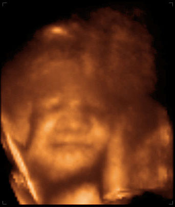 3d ultrasound image