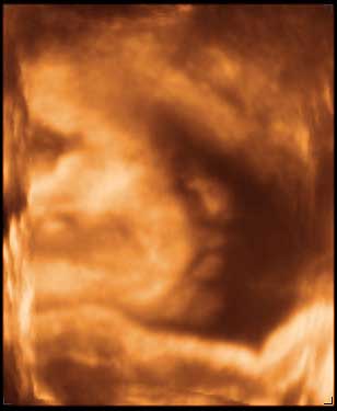 thumbnail of ultrasound at 33 weeks