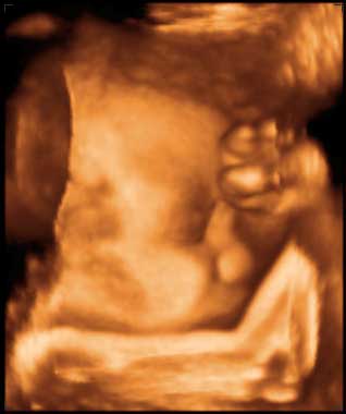 thumbnail of ultrasound at 33 weeks