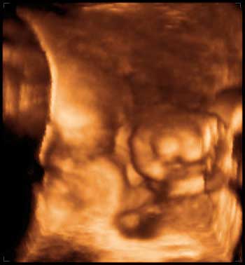 thumbnail of ultrasound at 33 weeks