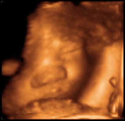 thumbnail of ultrasound at 33 weeks