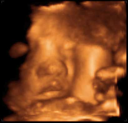 thumbnail of ultrasound at 33 weeks