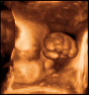 thumbnail of ultrasound at 33 weeks