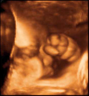 thumbnail of ultrasound at 33 weeks