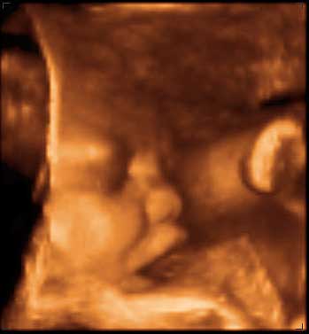 3d ultrasound image