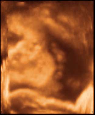 thumbnail of ultrasound at 33 weeks