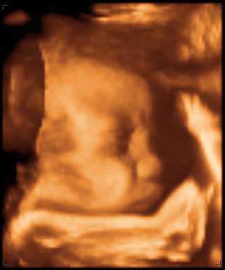 thumbnail of ultrasound at 33 weeks