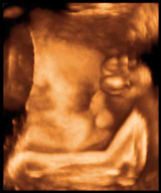 thumbnail of ultrasound at 33 weeks