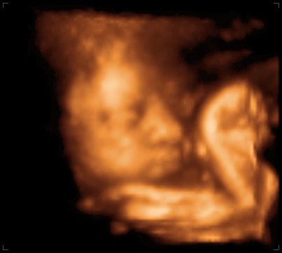 3d ultrasound image