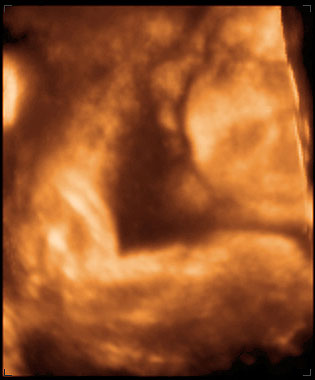 thumbnail of ultrasound at 37 weeks