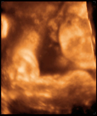 thumbnail of ultrasound at 37 weeks