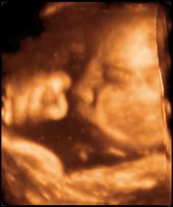 3d ultrasound image