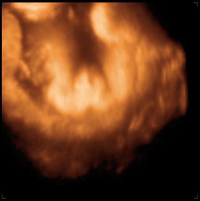thumbnail of ultrasound at 34 weeks, female