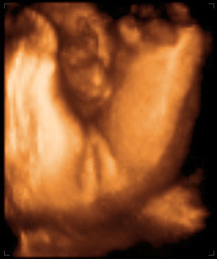 thumbnail of ultrasound at 34 weeks, female