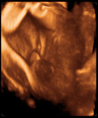 thumbnail of ultrasound at 31 weeks, male