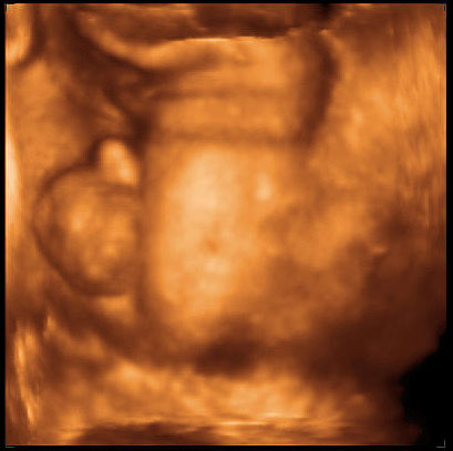 thumbnail of ultrasound at 31 weeks, male