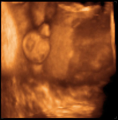 thumbnail of ultrasound at 31 weeks, male