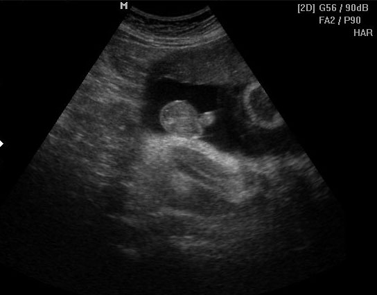 3d ultrasound image